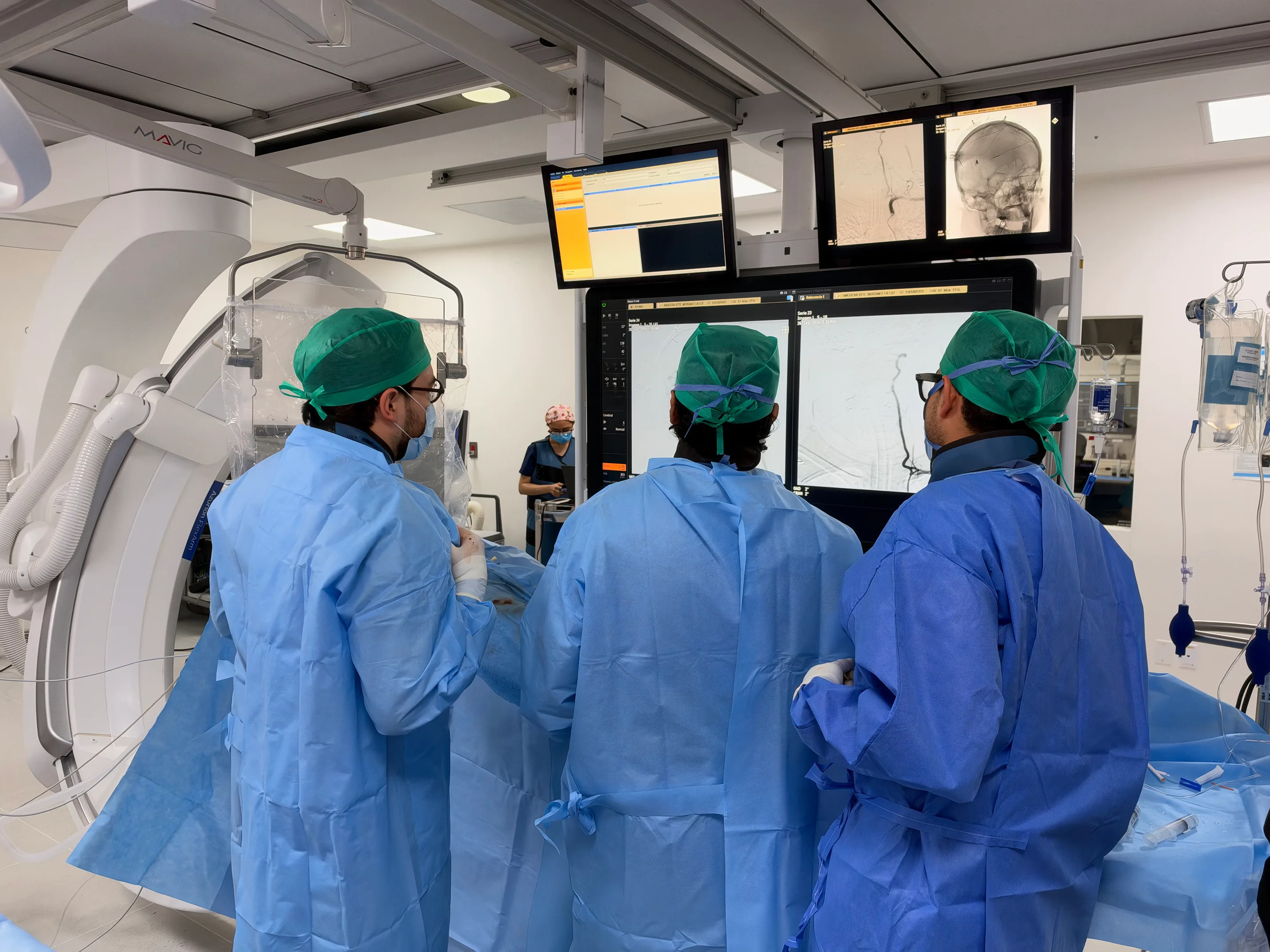 Embolización de aneurismas cerebrales